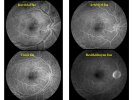 Üveitelerde-Fundus-Görüntüleme-08.jpg Üveitelerde-Fundus-Görüntüleme-08.jpg