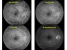 Üveitelerde-Fundus-Görüntüleme-08.jpg