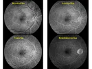 Üveitelerde-Fundus-Görüntüleme-08.webp