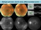 Üveitelerde-Fundus-Görüntüleme-16.jpg Üveitelerde-Fundus-Görüntüleme-16.jpg