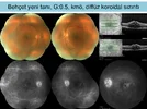 Üveitelerde-Fundus-Görüntüleme-16.webp