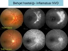 Üveitelerde-Fundus-Görüntüleme-18.webp