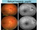 Üveitelerde-Fundus-Görüntüleme-19.jpg Üveitelerde-Fundus-Görüntüleme-19.jpg