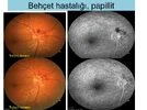 Üveitelerde-Fundus-Görüntüleme-19.webp