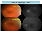 Üveitelerde-Fundus-Görüntüleme-20.webp