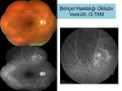 Üveitelerde-Fundus-Görüntüleme-21.webp