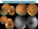Üveitelerde-Fundus-Görüntüleme-23.jpg Üveitelerde-Fundus-Görüntüleme-23.jpg