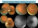 Üveitelerde-Fundus-Görüntüleme-23.webp