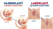 genital-estetik-ücreti.jpg genital-estetik-ücreti.jpg
