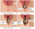 perineal-yirtiklar.jpg perineal-yirtiklar.jpg