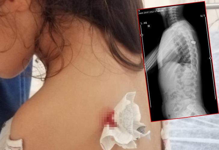 Böcek ısırığı sandılar, gerçek bambaşka çıktı! Aile öğrendiğinde neye uğradığını şaşırdı