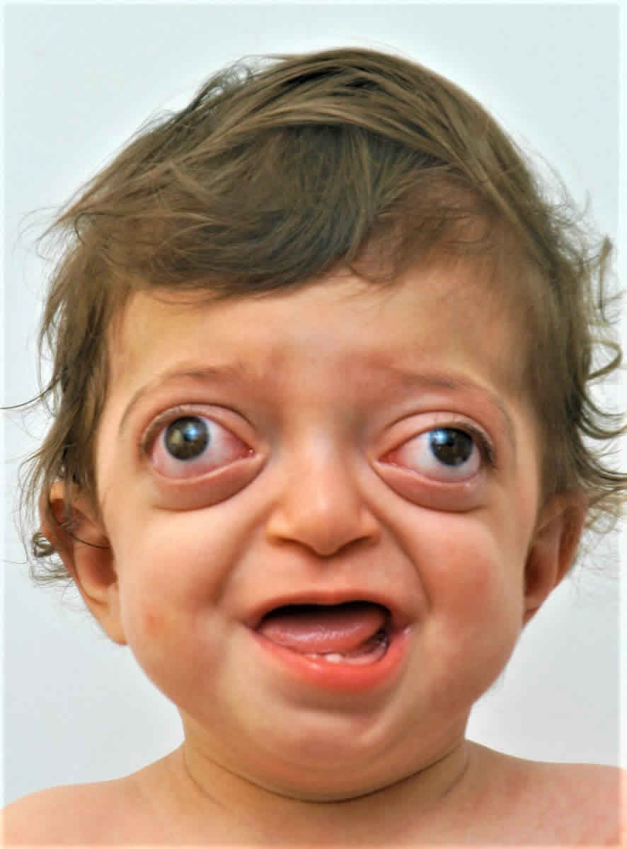 Crouzon-syndrome-1.jpg