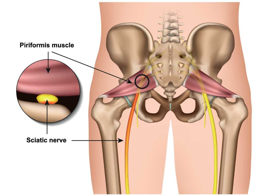 piriformis-sendromu-ferhat-gokmen.jpg