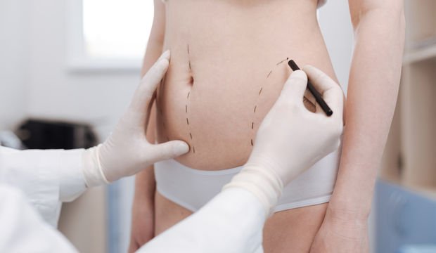 Liposuction hakkında merak edilenler