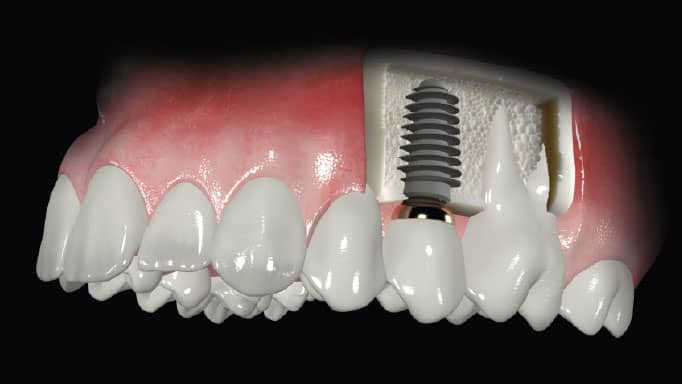 tek-dis-implant.jpg