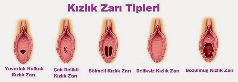 kizlik-zari-tipleri.jpg