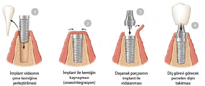 implant-dis-yapimi.jpg