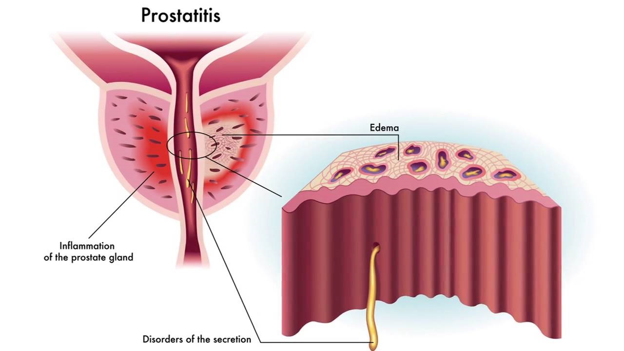 prostatit-1.jpg